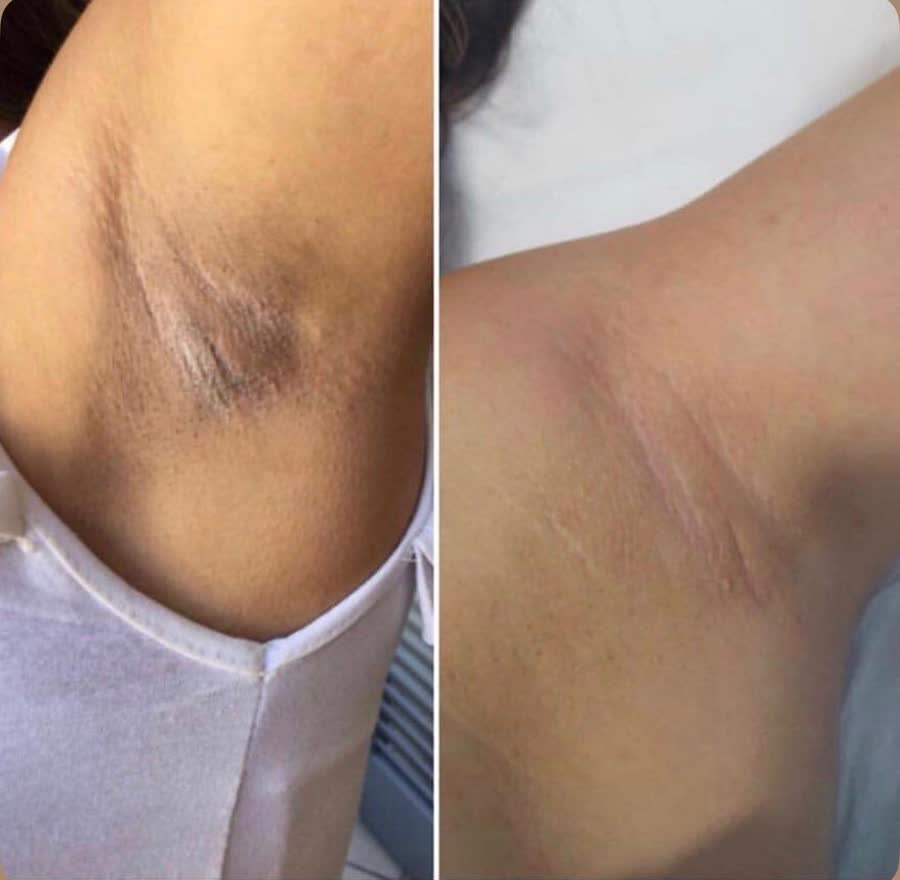 Blanqueado / Peeling Corporal (por zona)