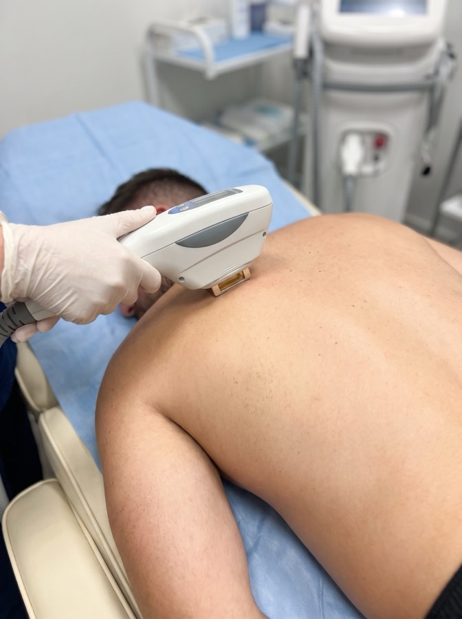 IPL Piernas, axilas, inglés, pubis y perianal