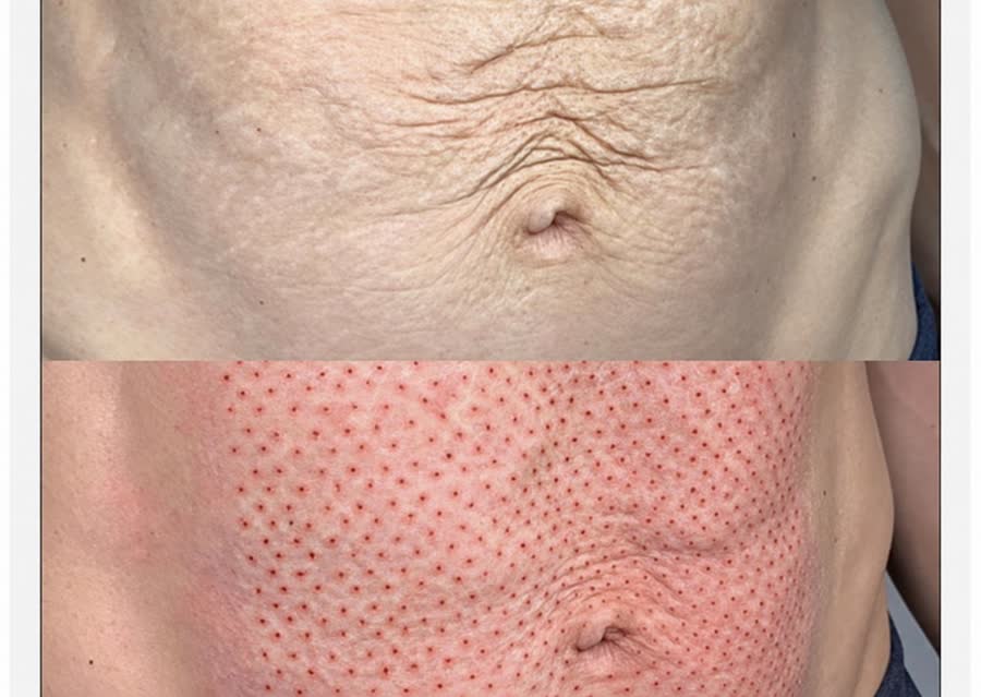 Plasma Pen · abdomen o brazos